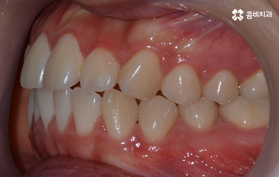 돌출입발치교정 기대해봐도 될까요 관련 이미지 3