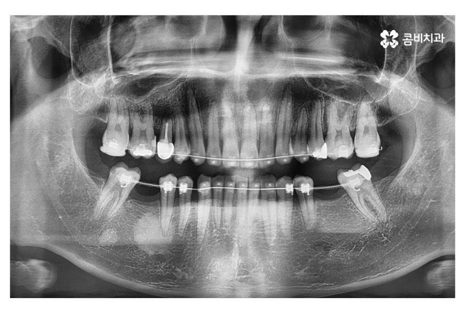 20대임플란트 잦아지는 이유를 알아본다면 관련 이미지 9