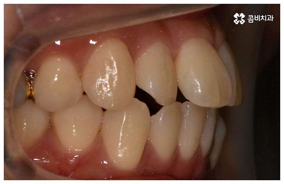 중년치아교정 원한다면 관련 이미지 3