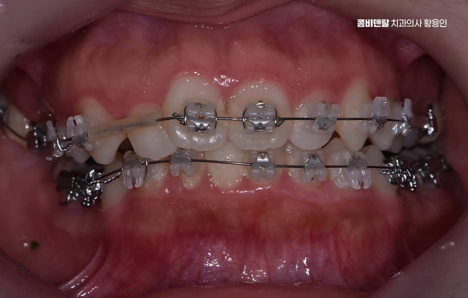 비발치 돌출입 교정 어떨때 적절할까 관련 이미지 6