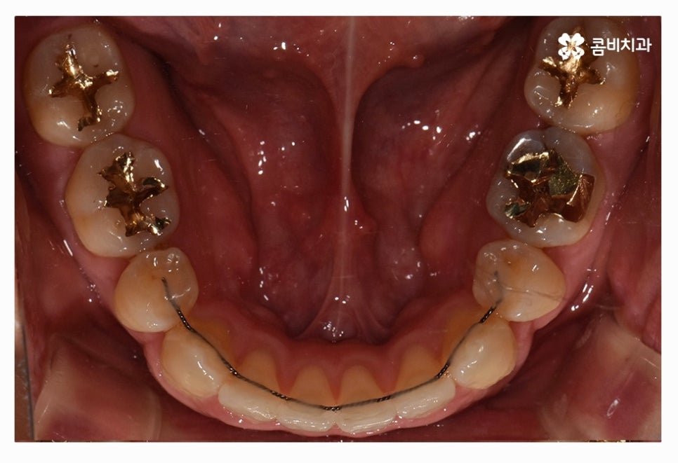클리피씨교정 올바르게 판단하려면 관련 이미지 16