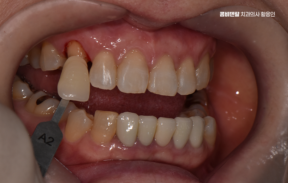 송곳니 크라운 티가 안나게 해결 가능한건가요 관련 이미지 3