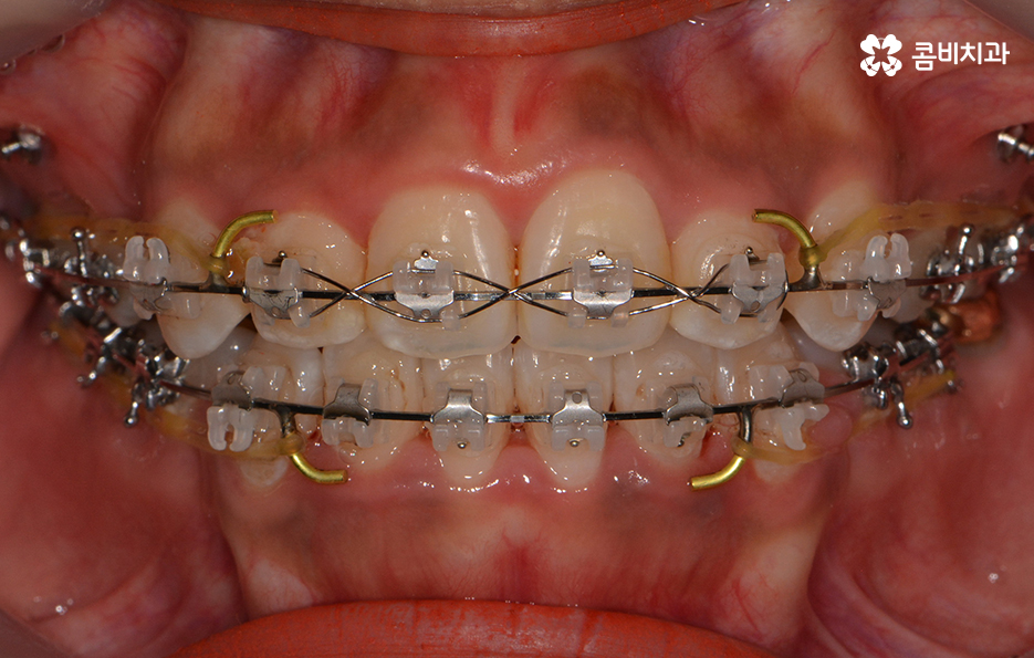 클리피씨교정 알아볼 때 꼭 신경 써야 하는 점은! 관련 이미지 7