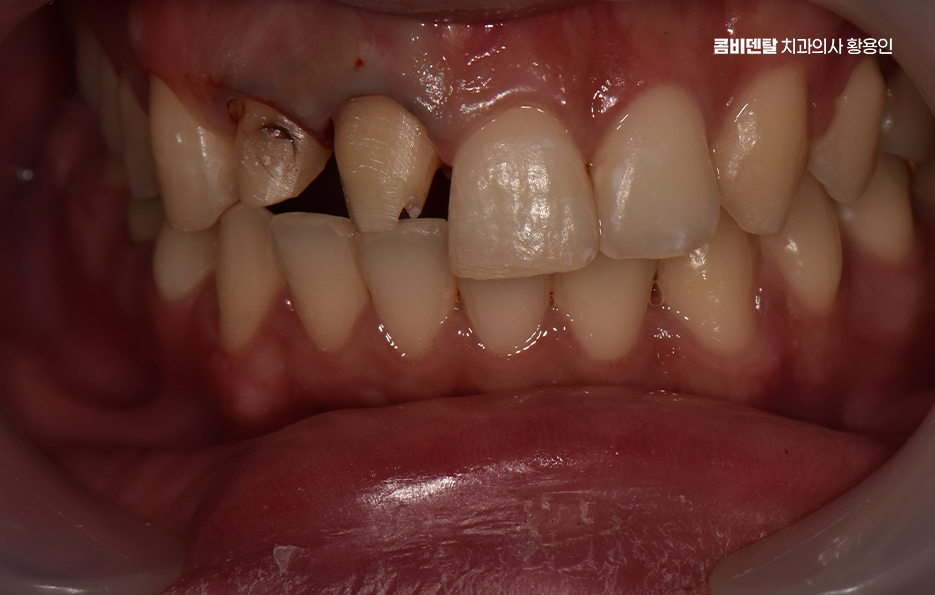 깨진 앞니 크라운 어떻게 해야 깔끔하게 해결될까 관련 이미지 2