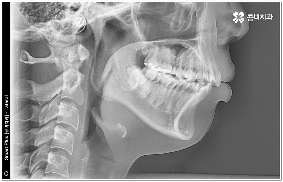 덧니부분교정 시작하려면 관련 이미지 1