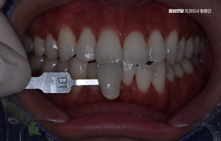 치과 치아미백 효과 어떤식으로 나타날까 관련 이미지 8