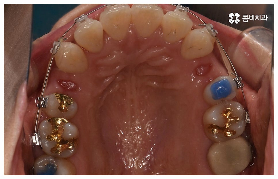 중년치아교정 원한다면 관련 이미지 9