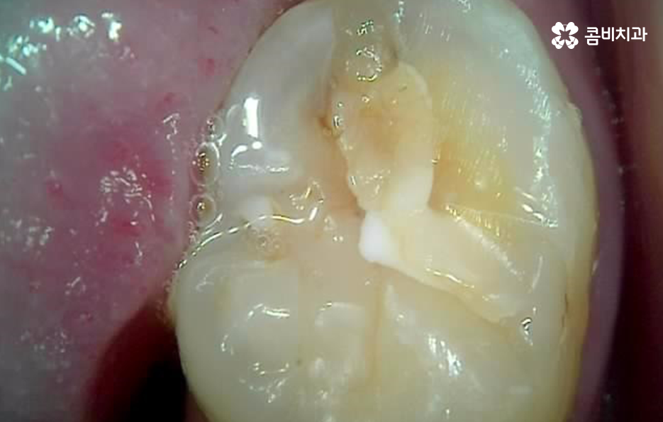 레진 인레이 치료 후 2차충치 왜 발생하고 어떻게 대처할까 관련 이미지 4