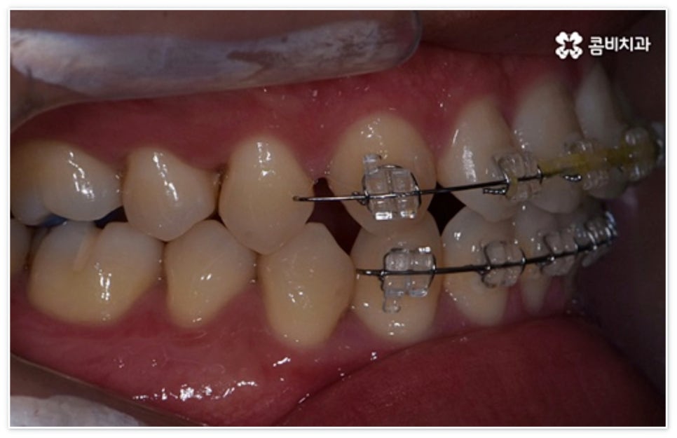 앞니 벌어짐 고치고 싶어요 관련 이미지 9
