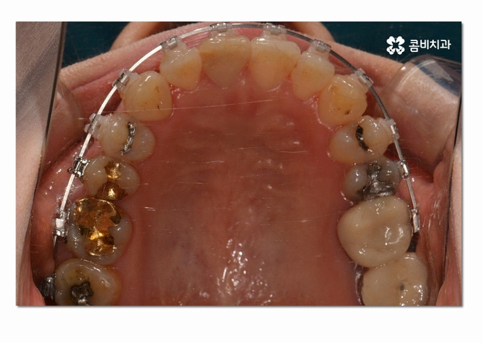 3급 부정교합 지금이라도 고치고 싶다면 관련 이미지 12