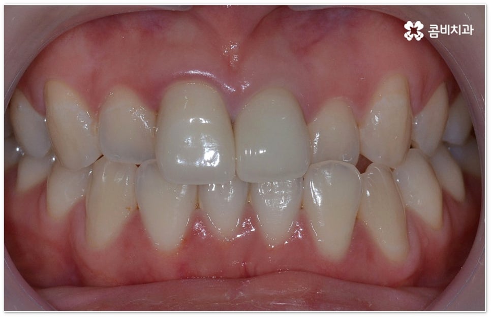 치아교정장치 어떻게 고르나요 관련 이미지 3