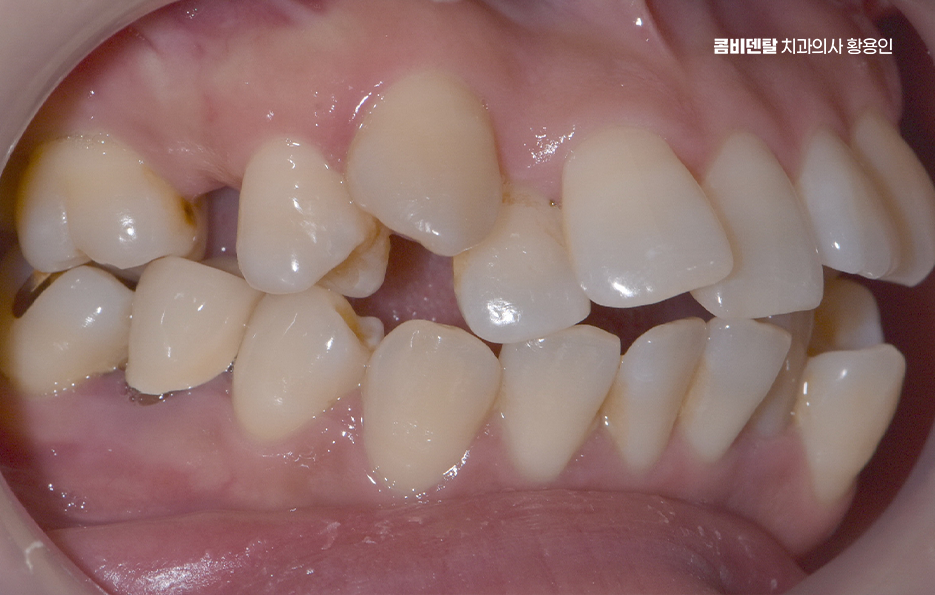 앞니 틀어짐 교정 조화롭게 마무리하려면 관련 이미지 2