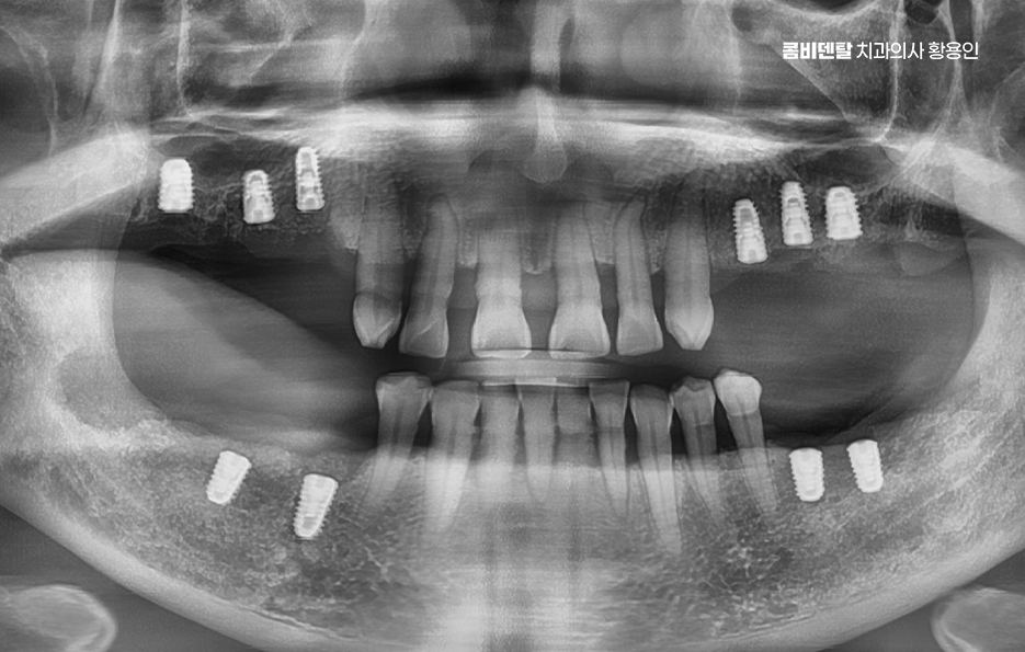 어금니 발치후 임플란트 안하면 어떻게 변하는걸까 관련 이미지 8