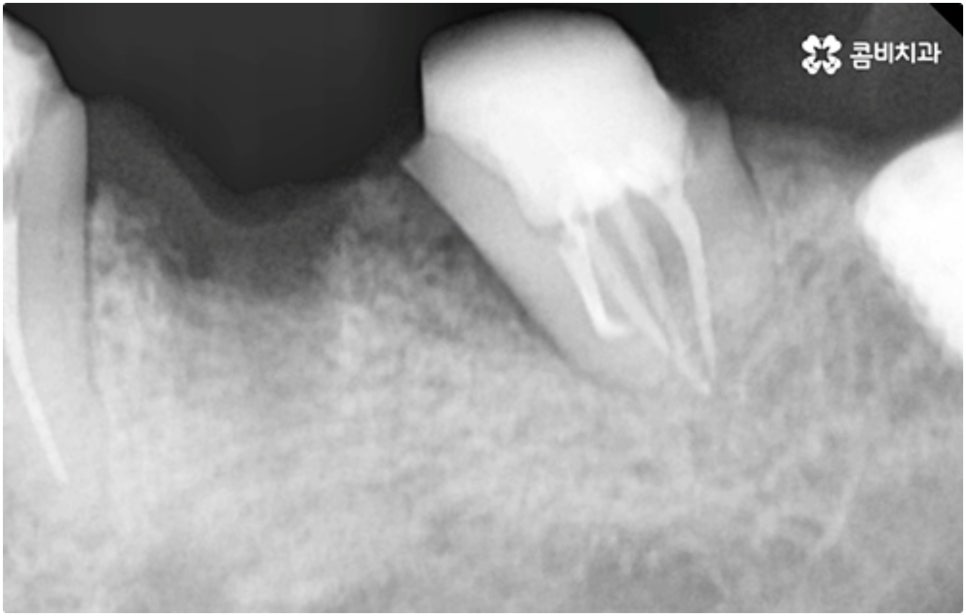 어금니임플란트 살펴볼 사항들은 무엇인가요? 관련 이미지 12