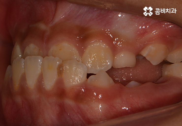 성장기치아교정 어떻게 접근하는 것이 좋을까 관련 이미지 2