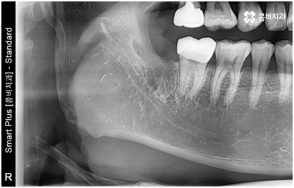 매복사랑니발치치과 어디로 가나요? 관련 이미지 6