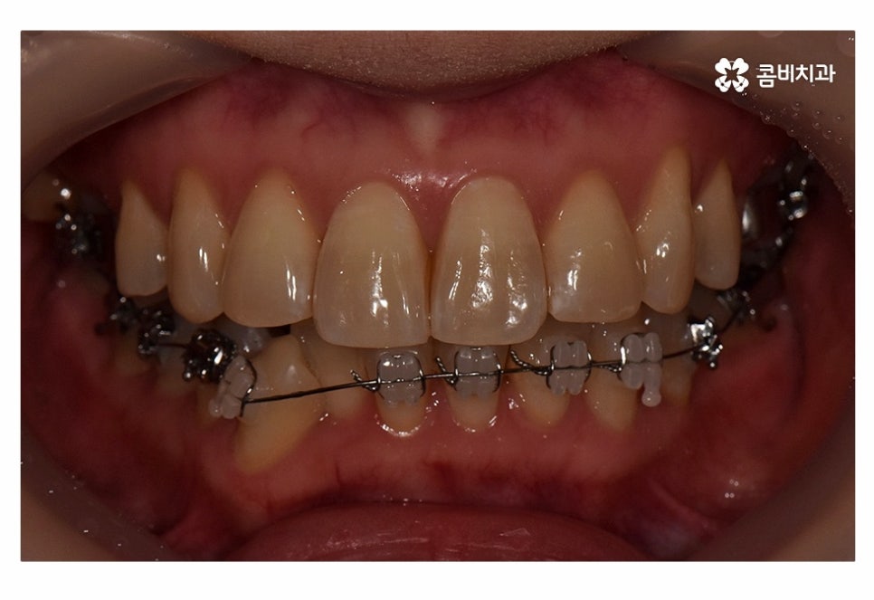 치아설측교정 가능한지 궁금하다면 관련 이미지 5
