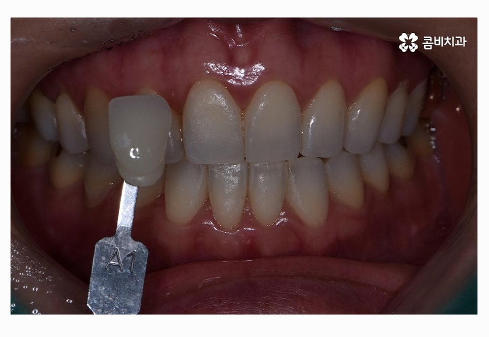 누런이로 고민하시는 분들을 위한 치아미백 정보 관련 이미지 4