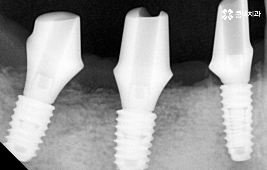 노인임플란트 이것만큼은 기억하세요 관련 이미지 7