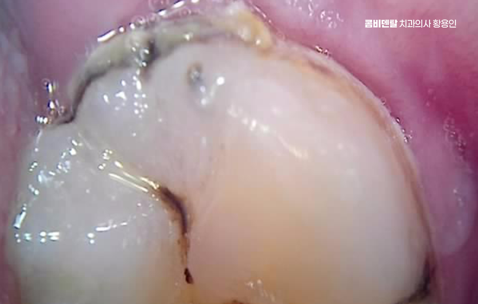 치아 시림 통증 갈수록 심해지다면 관련 이미지 14