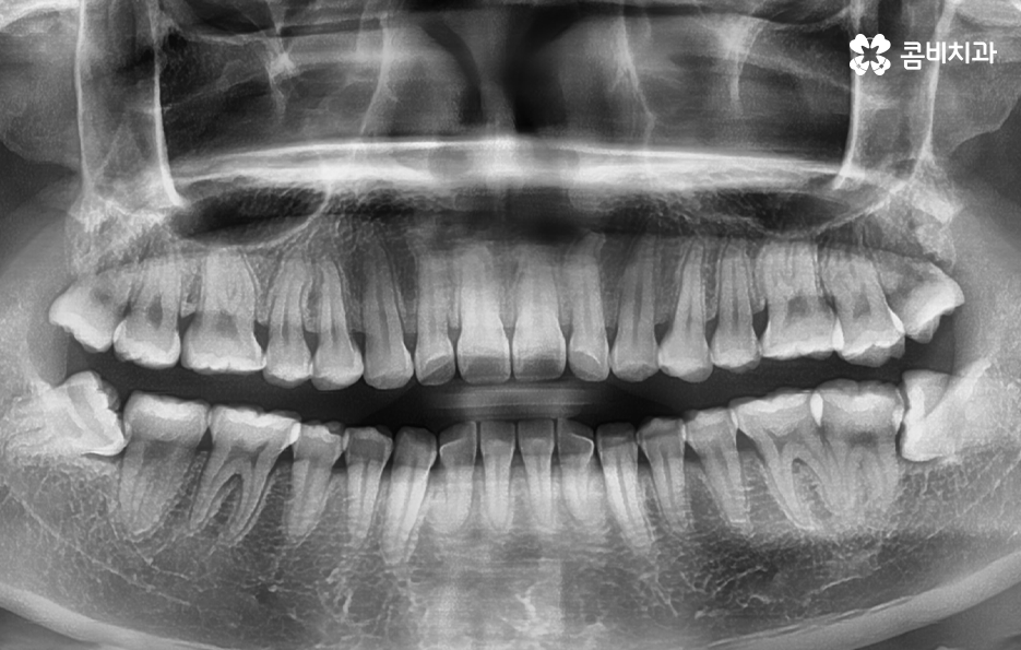 사랑니발치통증 이렇게 해야 쉬워져요 관련 이미지 1