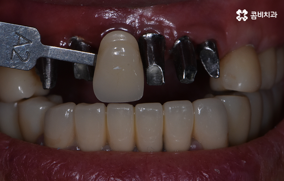 65세이상임플란트 고령이기에 간과하지 말아야 할 사항은 관련 이미지 9