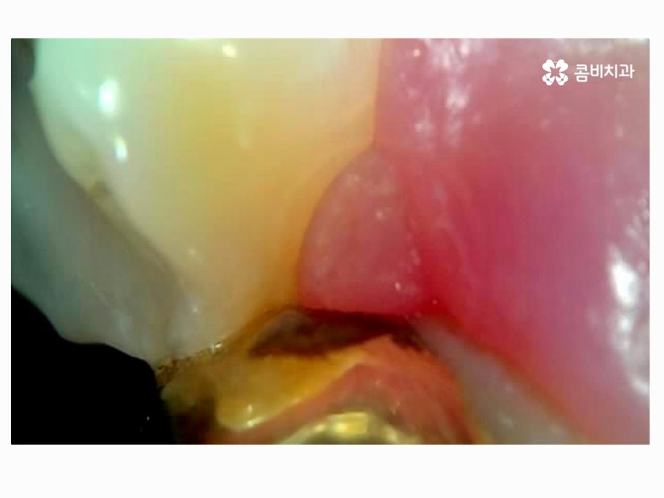 명동치과 누구나 놓치기 쉬운 문제점은! 관련 이미지 6