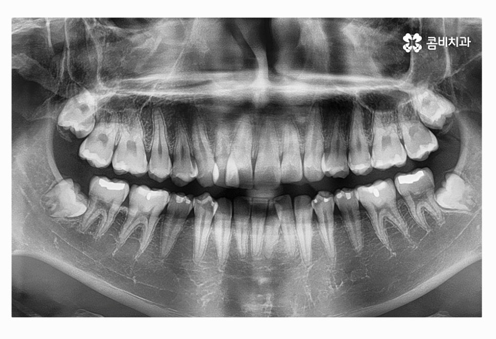 사랑니 충치 현명하게 접근하려면 관련 이미지 8