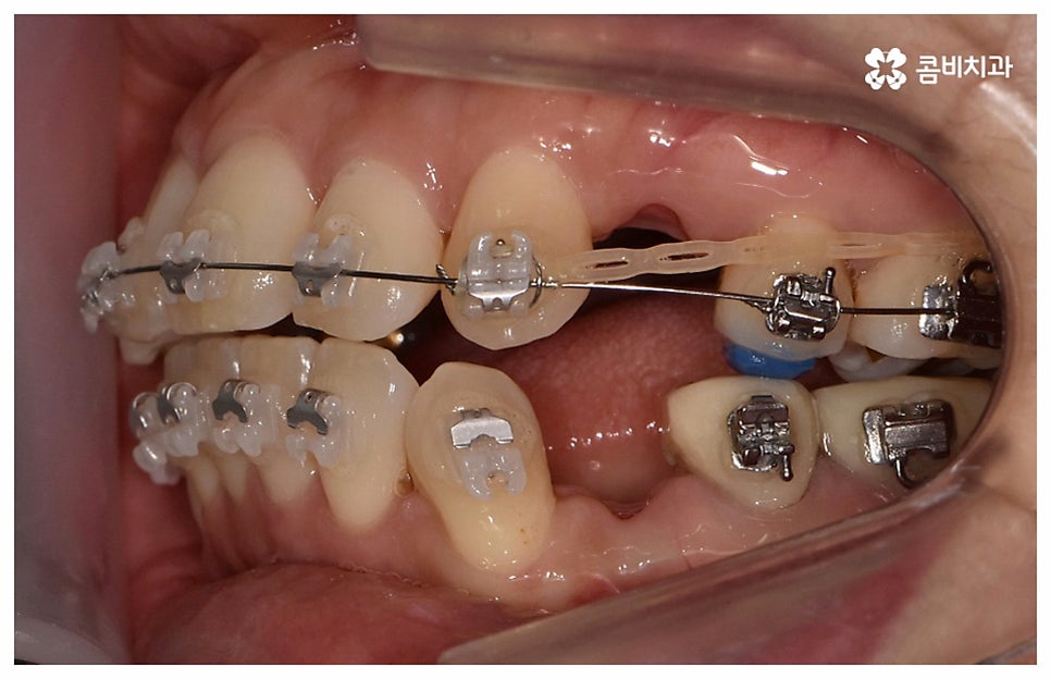 중년치아교정 원한다면 관련 이미지 8