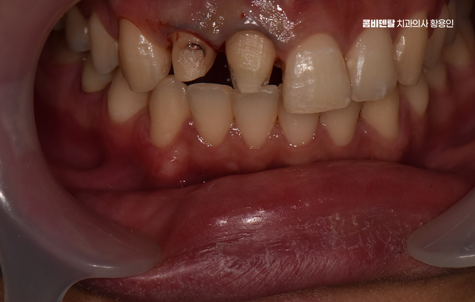 깨진 앞니 크라운 어떻게 해야 깔끔하게 해결될까 관련 이미지 3