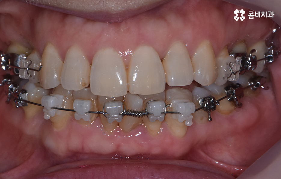 돌출입 콤비교정으로 얼굴까지 개선하는 방법은 관련 이미지 7