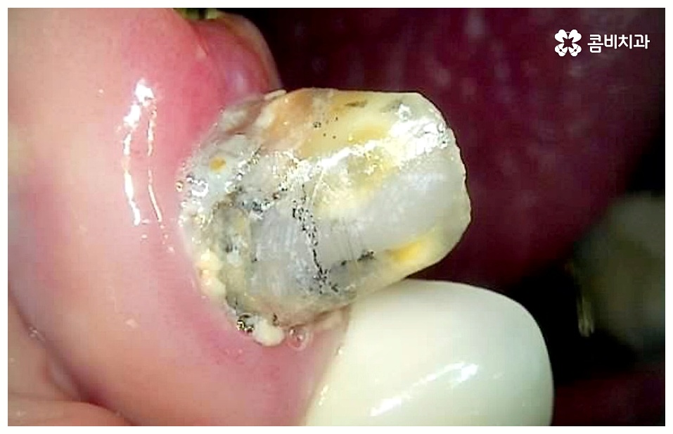 임플란트 치료기간 중점을 두어야 할것은 관련 이미지 2