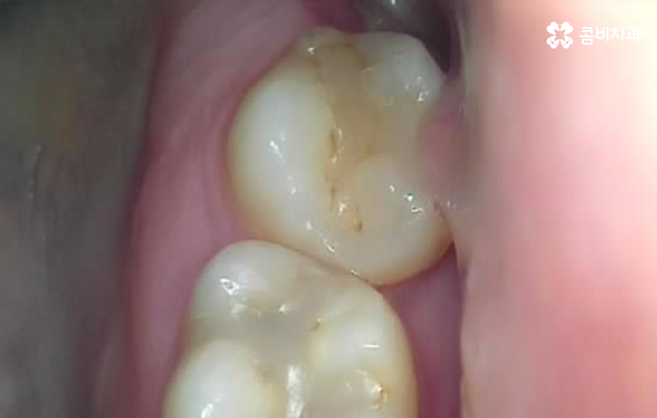 사랑니 어금니 통증 동시에 아프다면 관련 이미지 4
