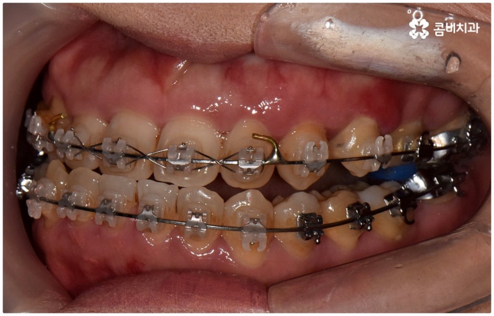 반대교합교정 늦지 않았어요 관련 이미지 11