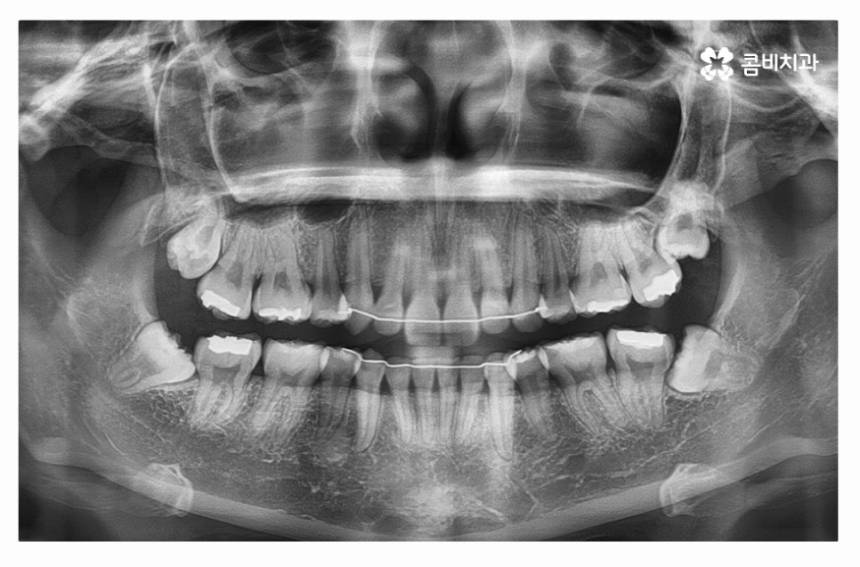 누운사랑니발치 언제 뽑을지 고민이라면 관련 이미지 1