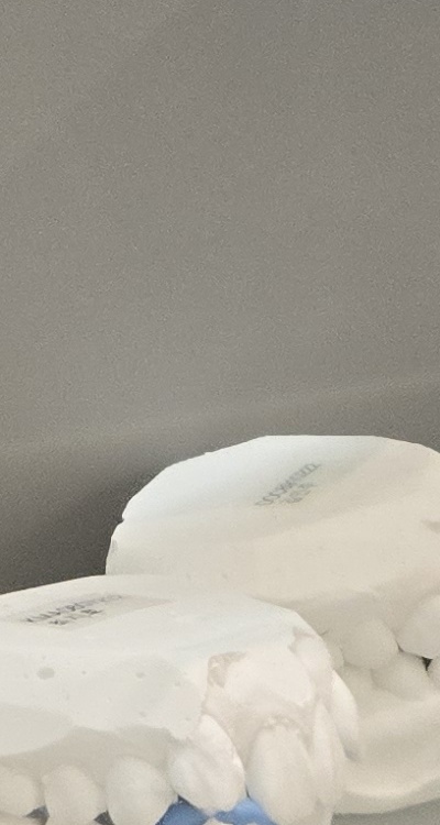 앞니 틀어짐 부분교정 얼마나 걸릴까 관련 이미지 36