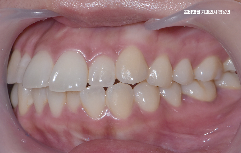 Could the Cause of Protruding Front Teeth Make a Difference? image 4