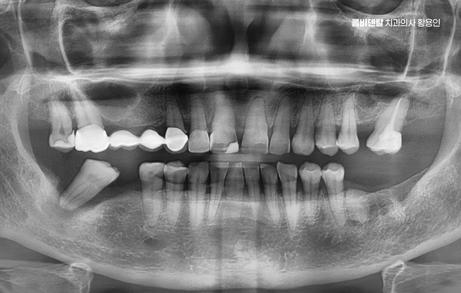 임플란트의 장점 할까 말까 고민이신 분들을 위한 정리 관련 이미지 1