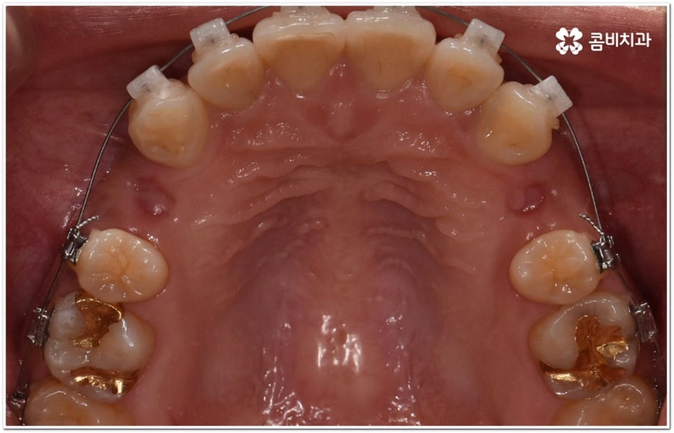 돌출입교정치과 알아보는 기준은 관련 이미지 10