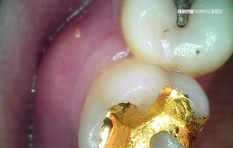 인레이 치료 후 신경치료 이유가 궁금하다면 관련 이미지 3