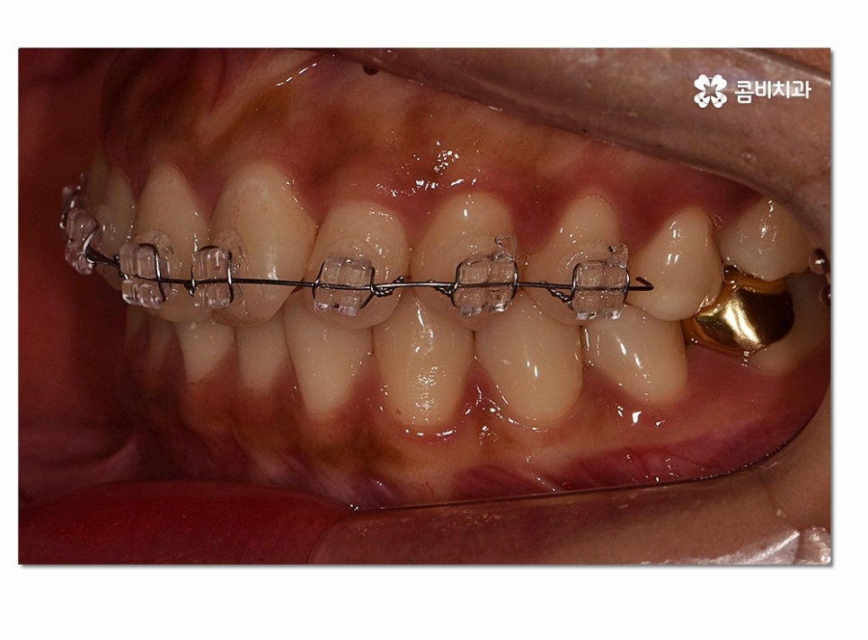 앞니 부분교정 오래 걸리지 않고 원하는 부위만 관련 이미지 8