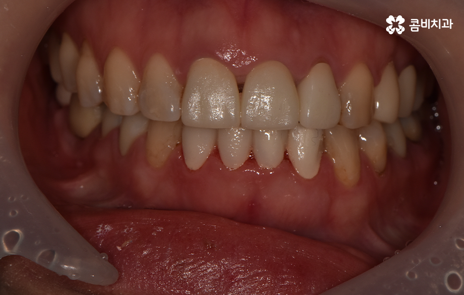 아래 앞니깨짐 치료 감쪽같이 해결하려면 관련 이미지 4