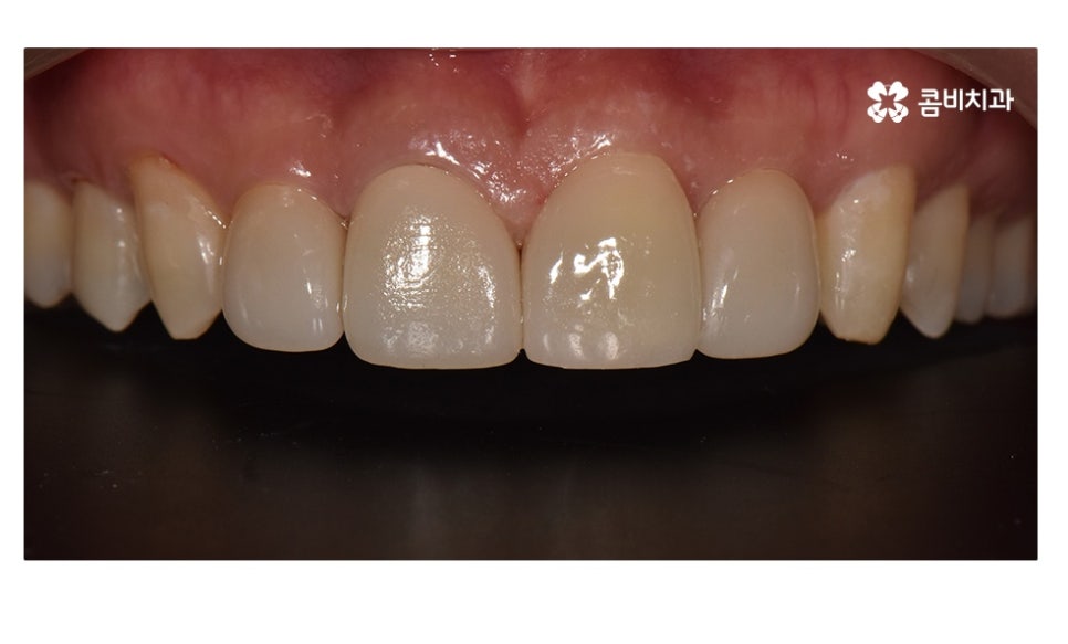 무삭제라미네이트 포인트부터 잘 알고 시작하려면 관련 이미지 5