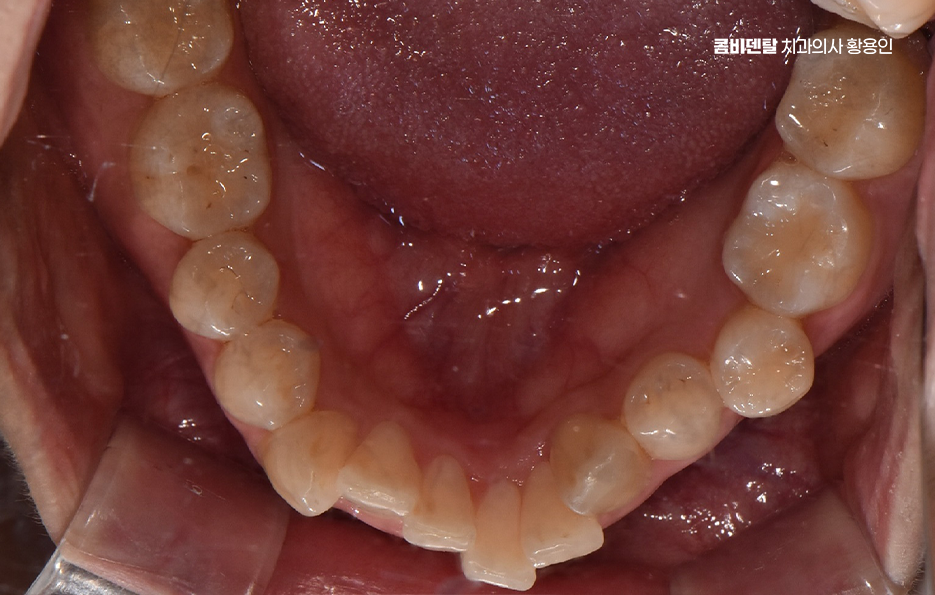 앞니 틀어짐 교정 이렇게 파악하세요 관련 이미지 7