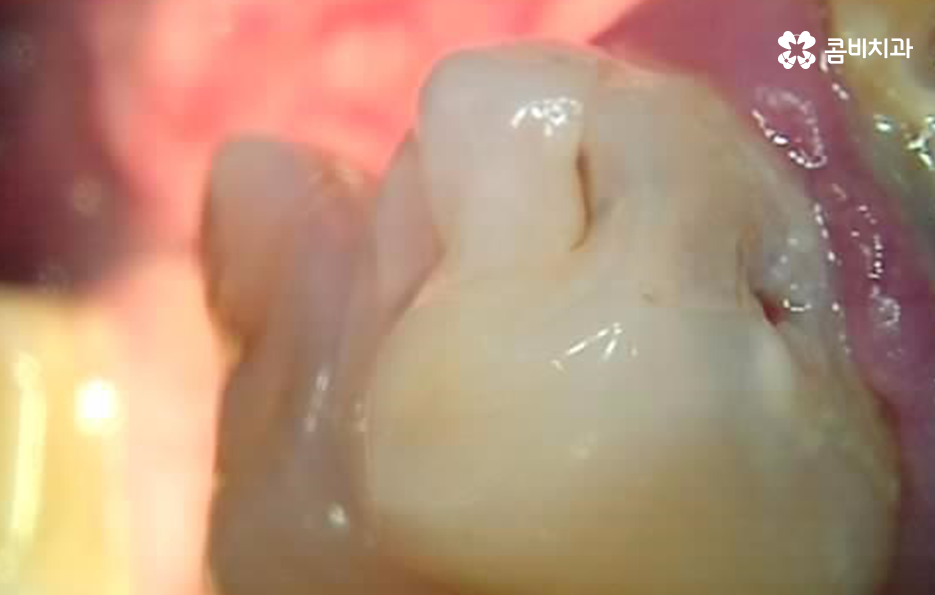 충치 단계 어떻게 분류하고 치료해야 하나요 관련 이미지 4