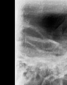 어금니 뒤 잇몸 부음 어떤 문제길래 이런거죠 관련 이미지 8