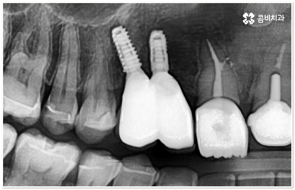 앞니임플란트 체크할 사항들은? 관련 이미지 4