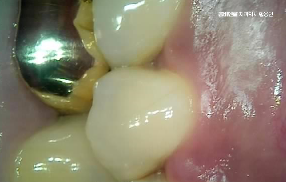 충치 치아 깨짐 시점이 관건이라면 관련 이미지 4