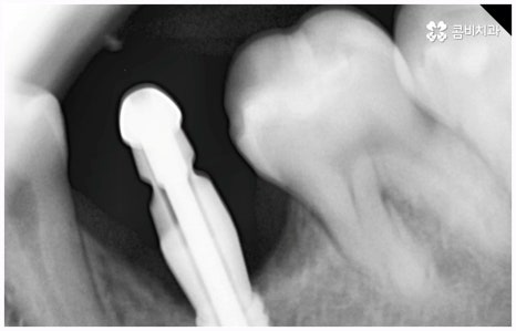 임플란트 종류 어떤게 맞을까요? 관련 이미지 6