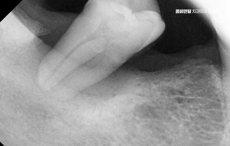임플란트의 장점 할까 말까 고민이신 분들을 위한 정리 관련 이미지 2